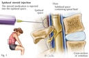 Epidural Steroid Enjeksiyonu Nedir?