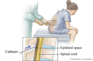 Epidural Analjezi Nasıl Uygulanır?