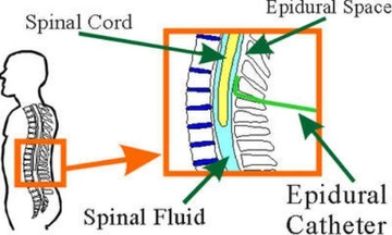 Epidural Anestezi Nasıl Yapılır?
