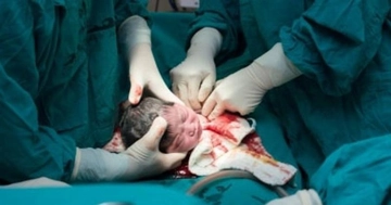 Normal Doğumda Epidural Anestezi